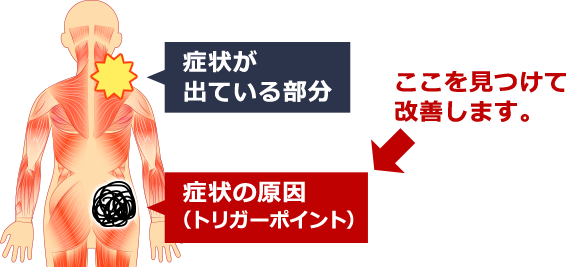 当院では本当の原因、トリガーポイントにアプローチ